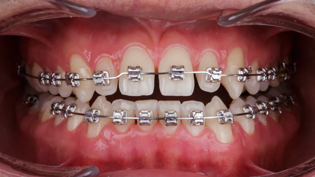 braces, orhtodontic treatment