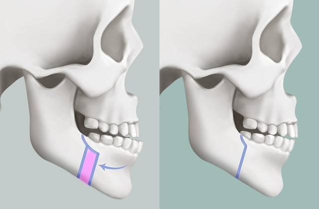 orthodontic surgery, jaw correction surgery