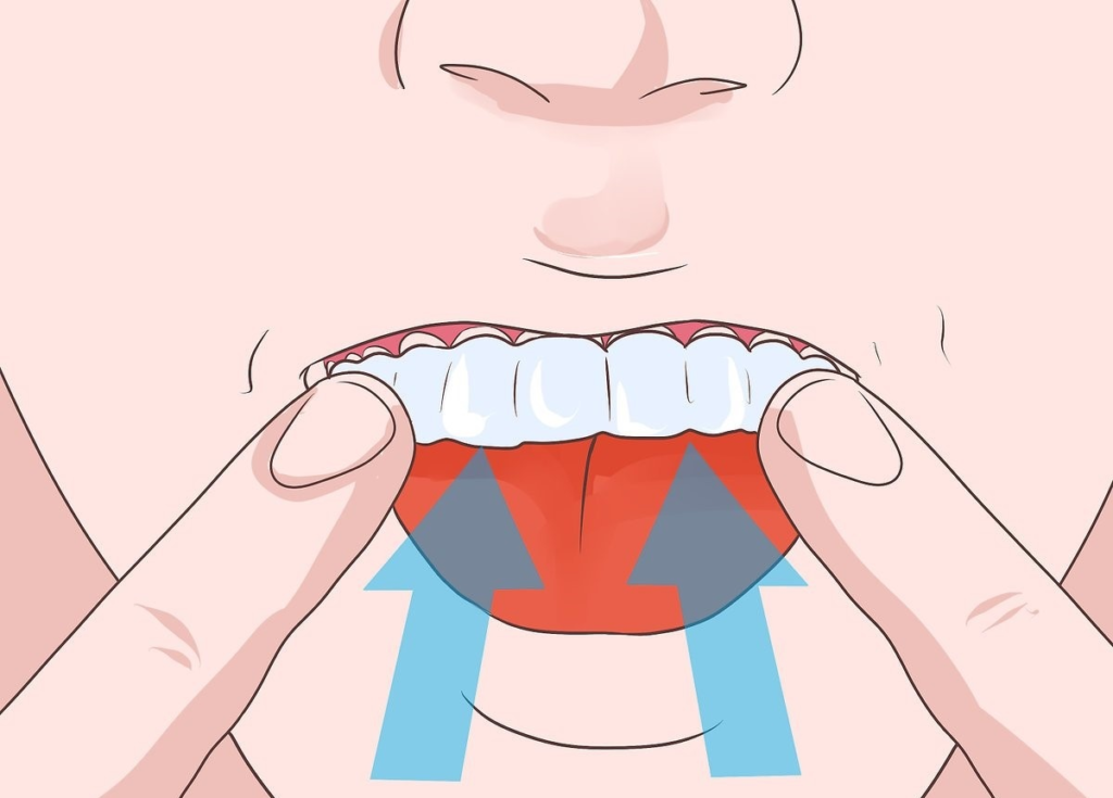 retainer, malocclusion