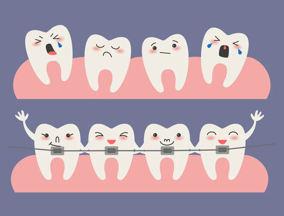braces. orthodontic surgery, malocclusion
