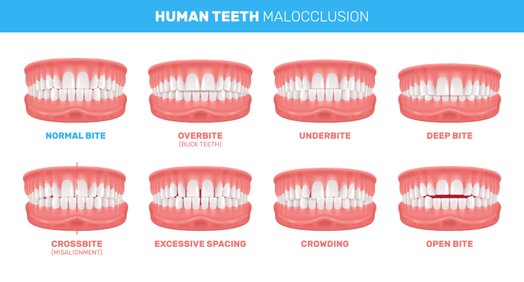 malocclusion