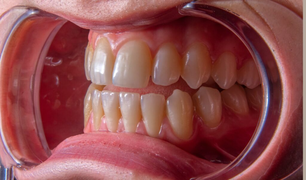 Flossing
