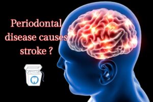 stroke periodontal disease floss dental flossing