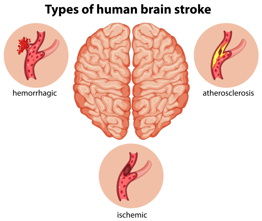 types of stroke